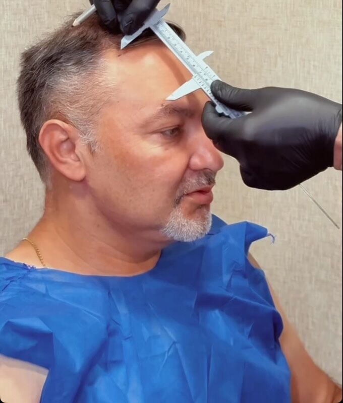 Marcação da linha frontal antes do transplante capilar